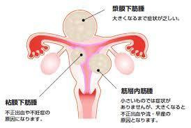 子宮のつくりと筋腫の種類